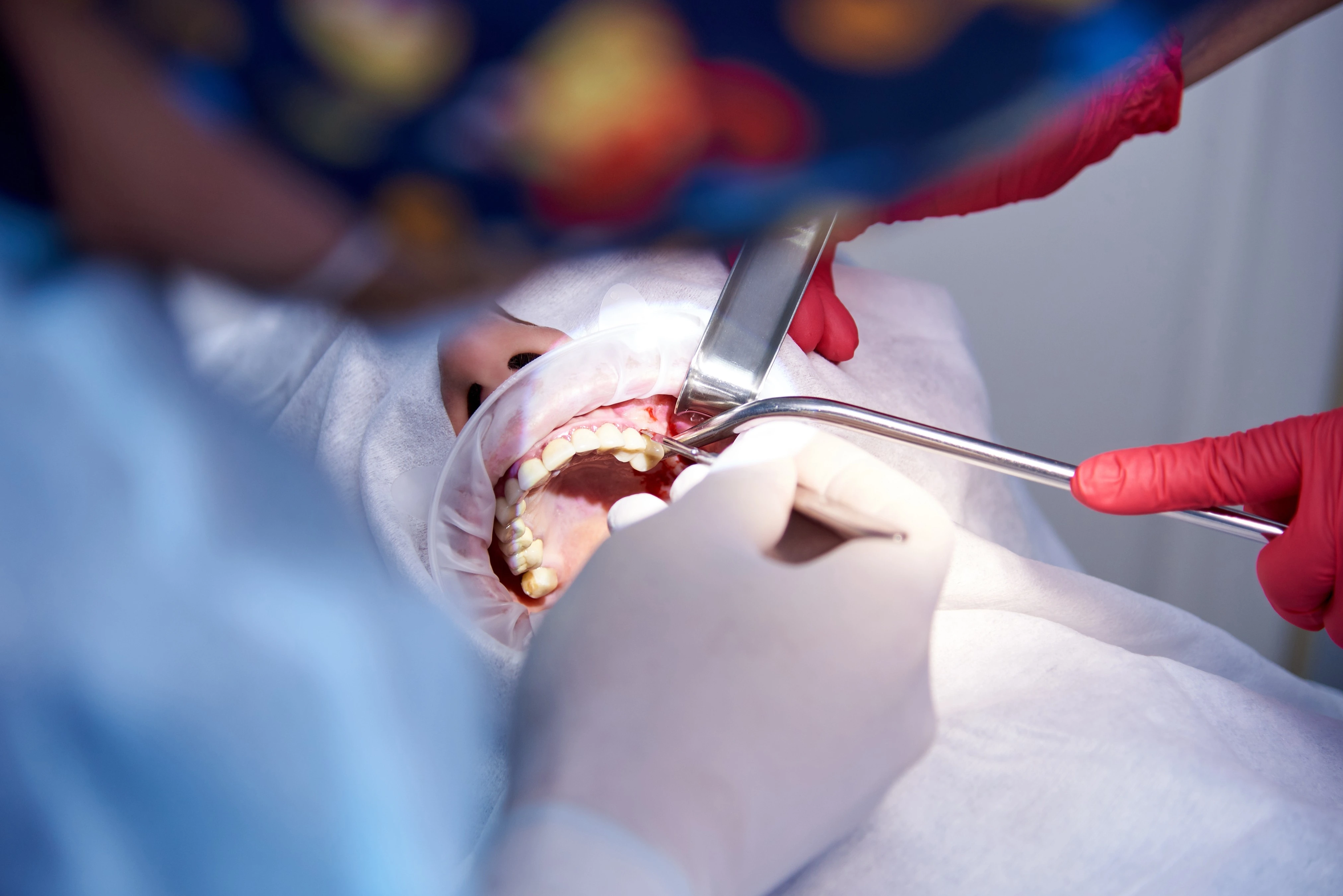 Wisdom Tooth Removal
